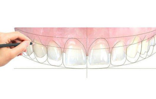 digital smile design