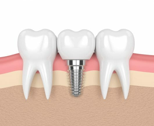 dental implants