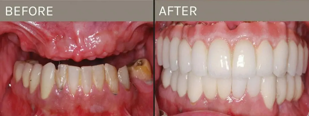 Check out the real smile transformations of patients at Garine & Boza Prosthodontics - Dental Implants